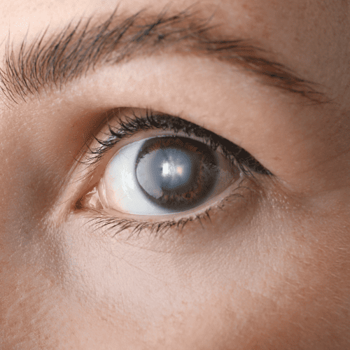 cirugia-de-cataratas-en-tijuana-costo