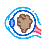 costo-cirugia-de-cataratas-en-tijuana